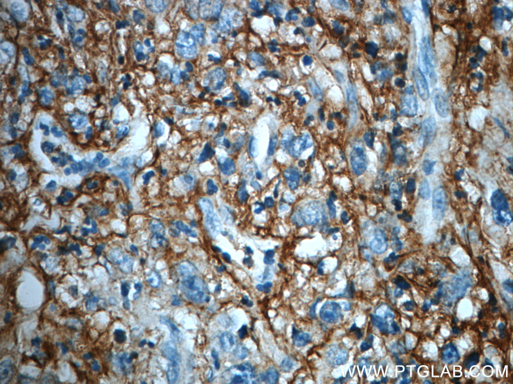 IHC staining of human stomach cancer using 21247-1-AP (same clone as 21247-1-PBS)