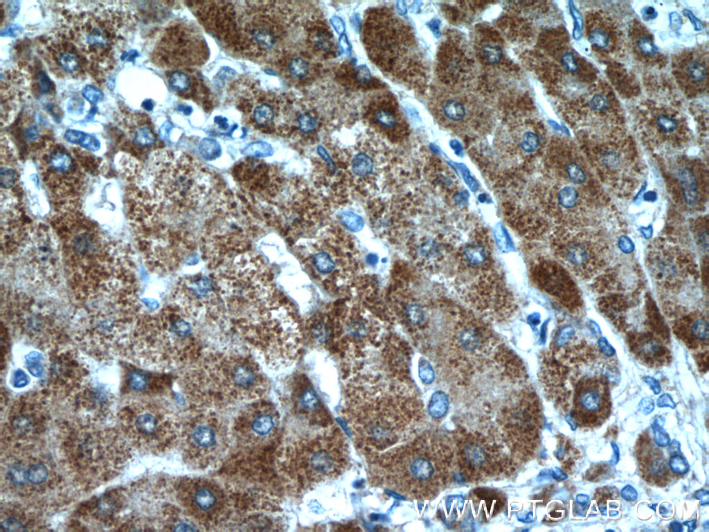 IHC staining of human hepatocirrhosis using 24069-1-AP