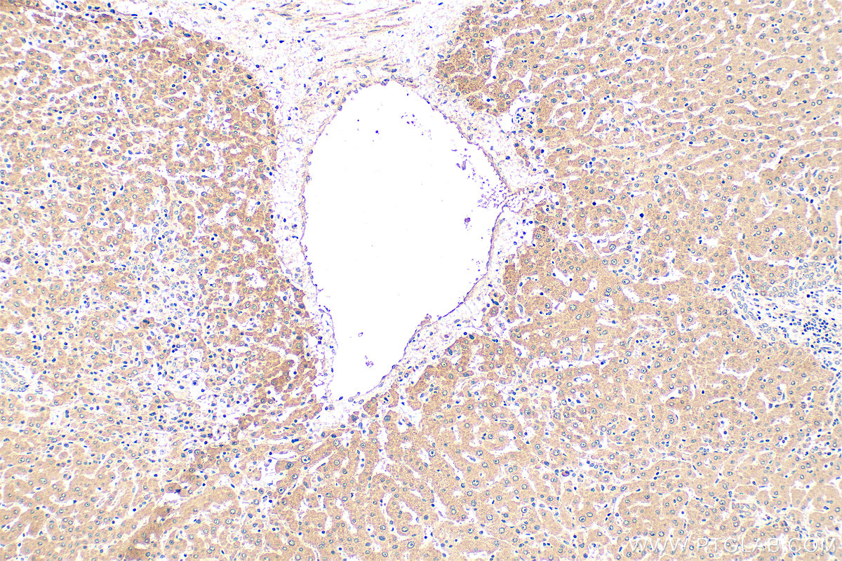 IHC staining of human hepatocirrhosis using 24069-1-AP