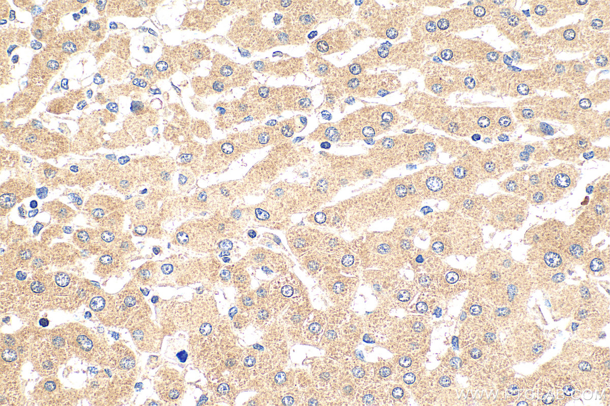 IHC staining of human hepatocirrhosis using 24069-1-AP