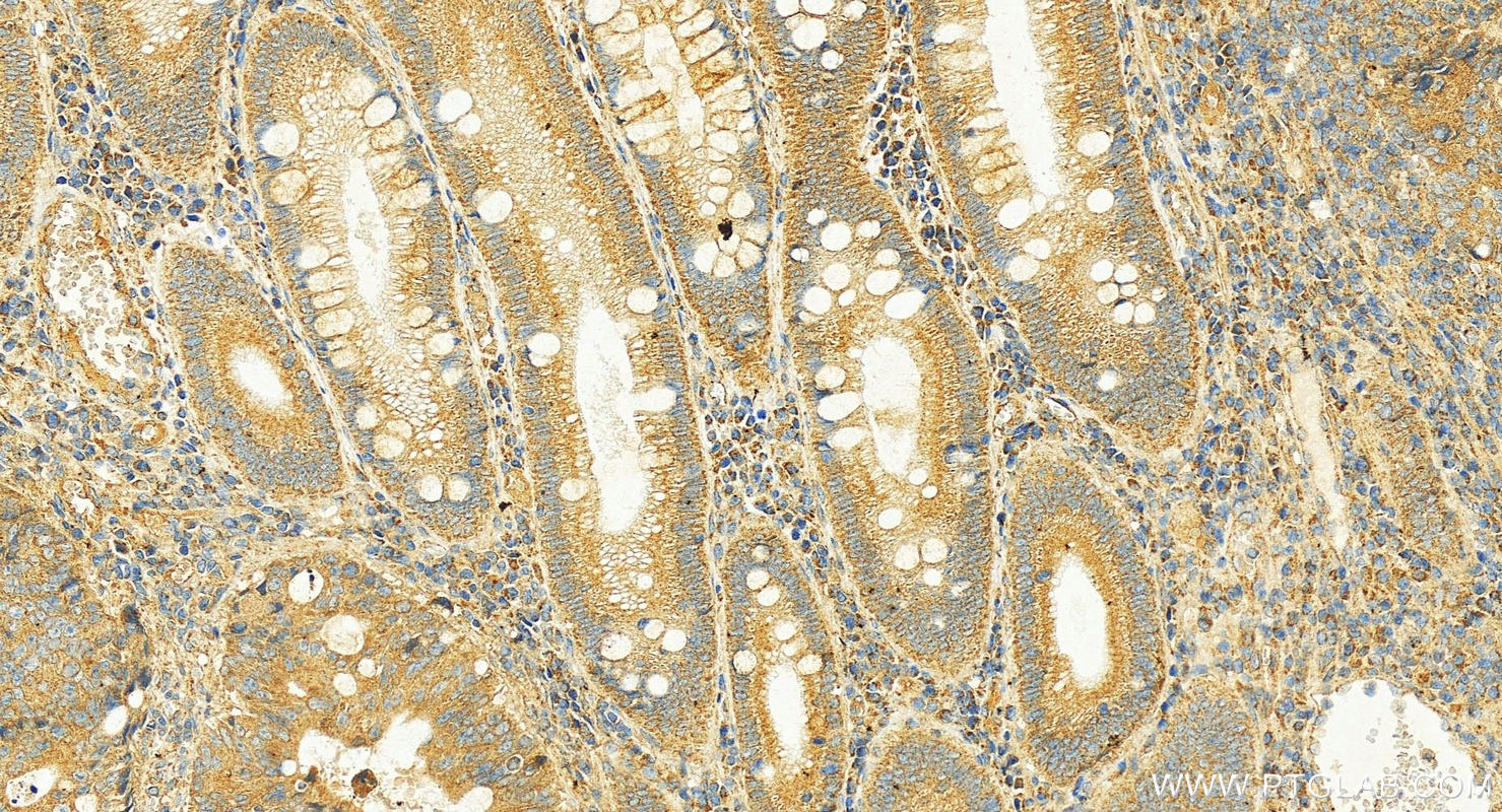 IHC staining of human colon cancer using 18815-1-AP