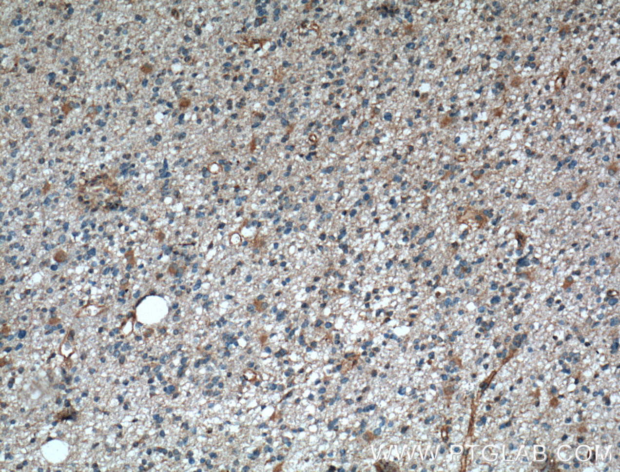 IHC staining of human gliomas using 14270-1-AP