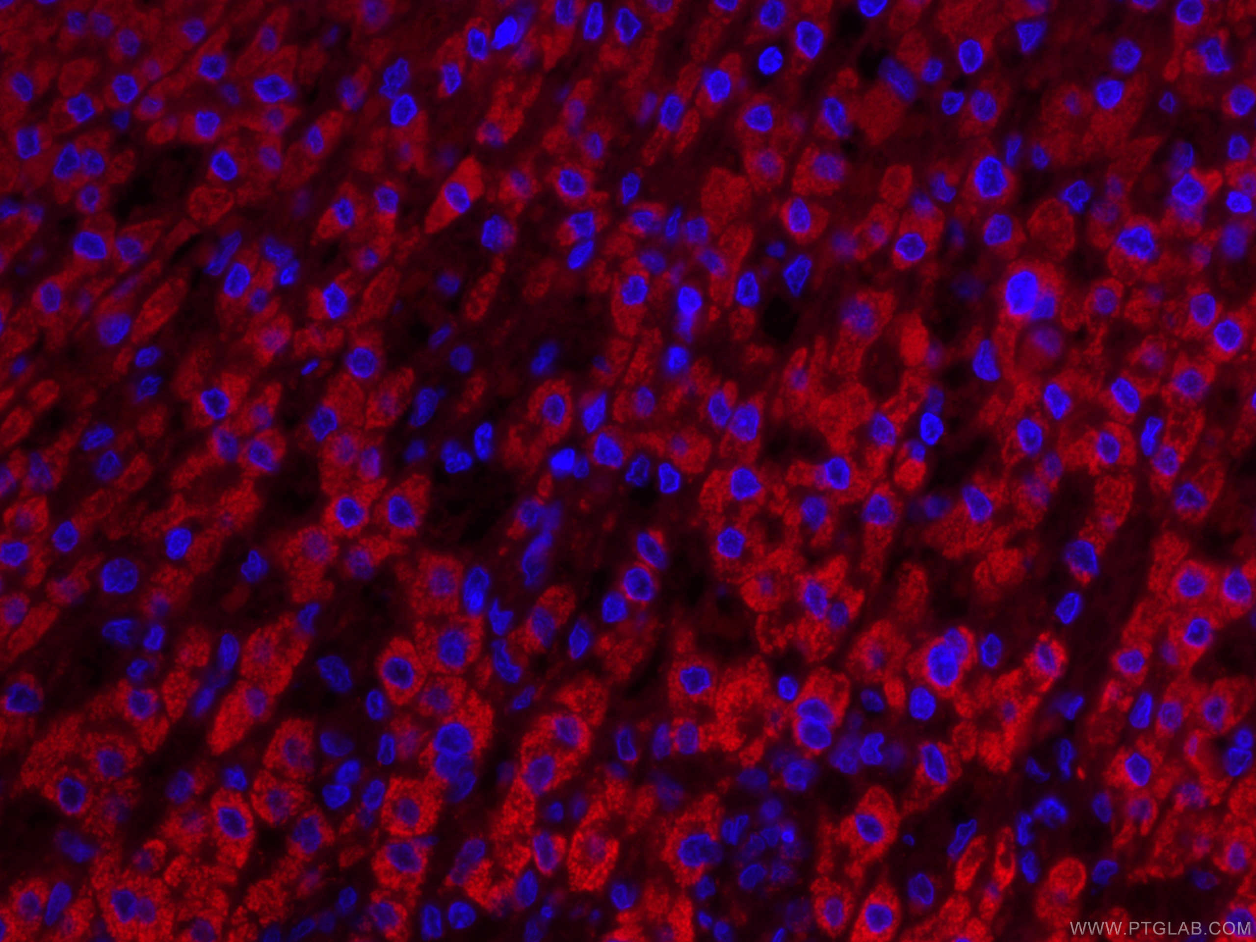 IF Staining of human liver cancer using CL594-66032