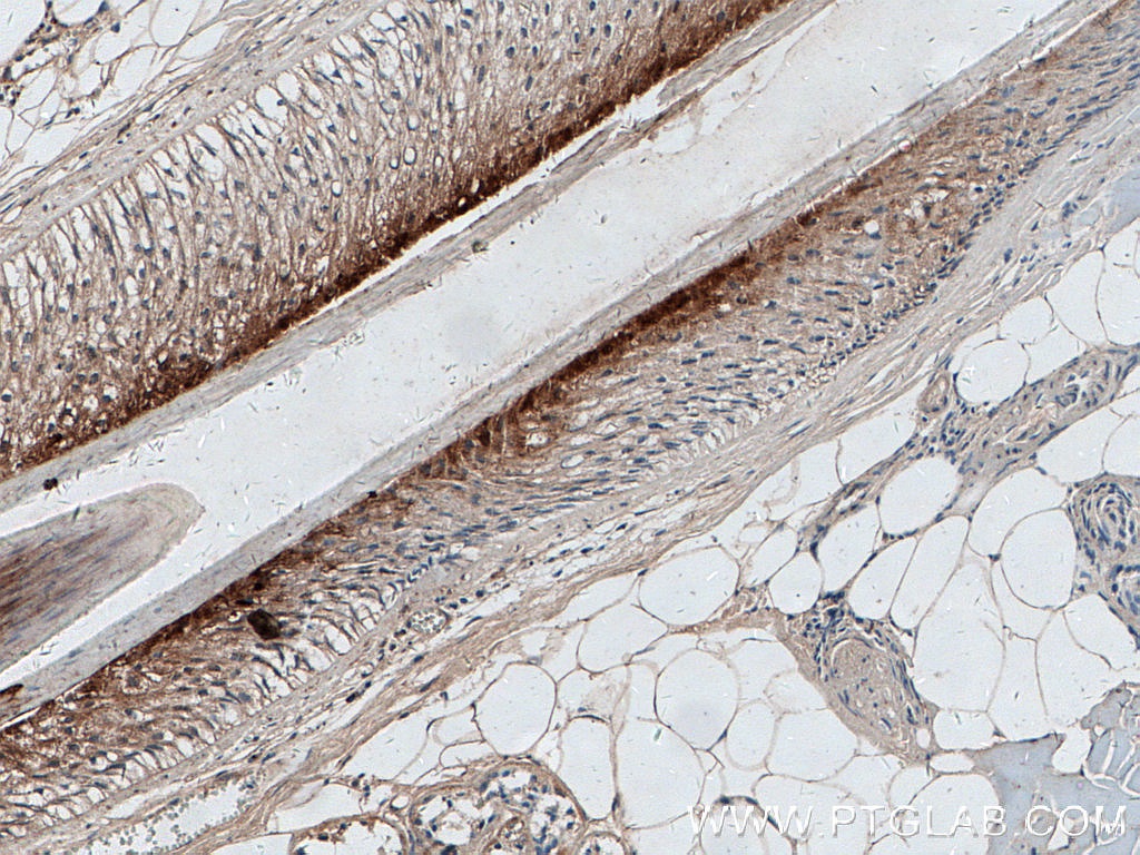 IHC staining of human skin cancer using 55328-1-AP