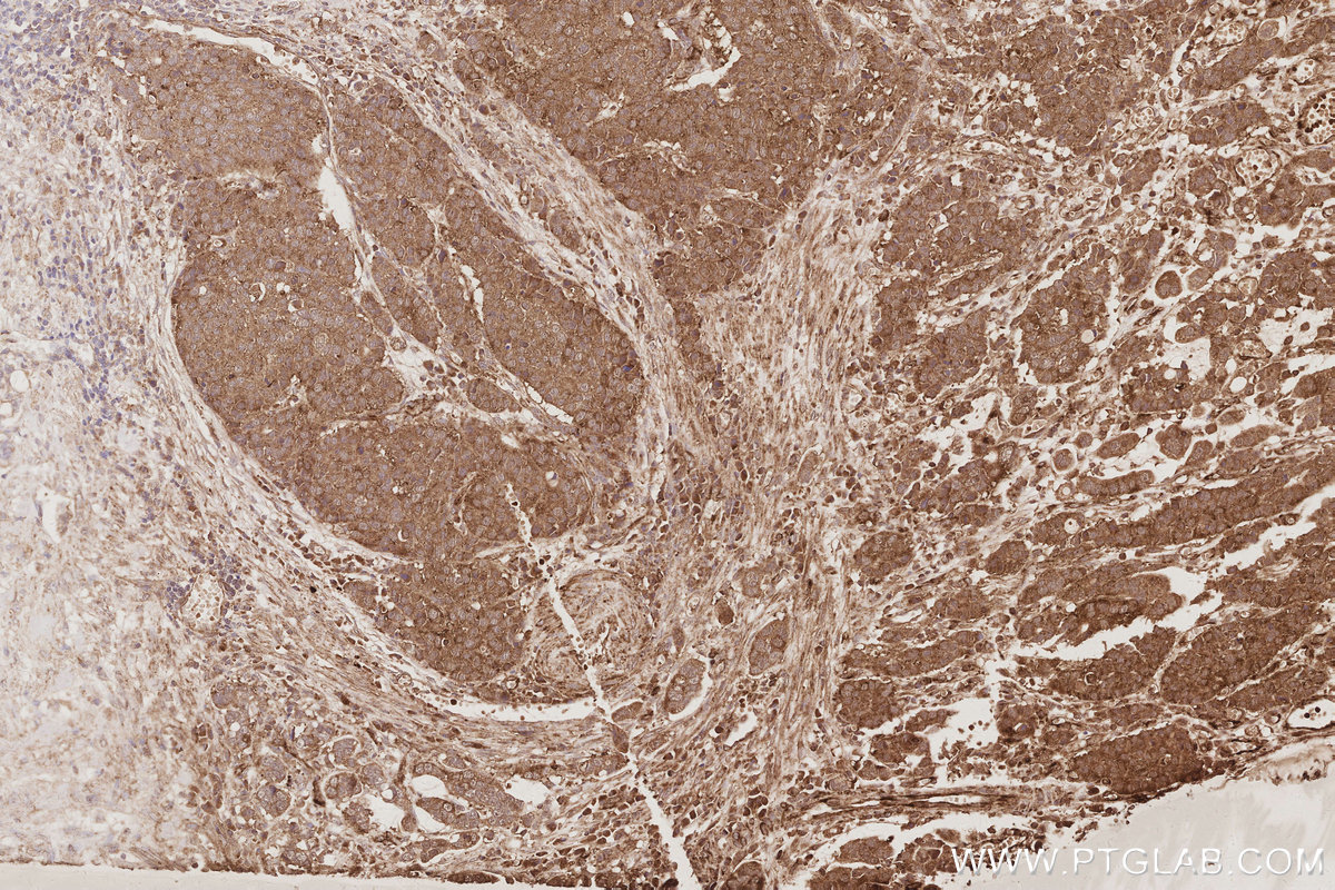 IHC staining of human stomach cancer using 84268-1-RR IHC staining of human stomach cancer using 84268-1-RR