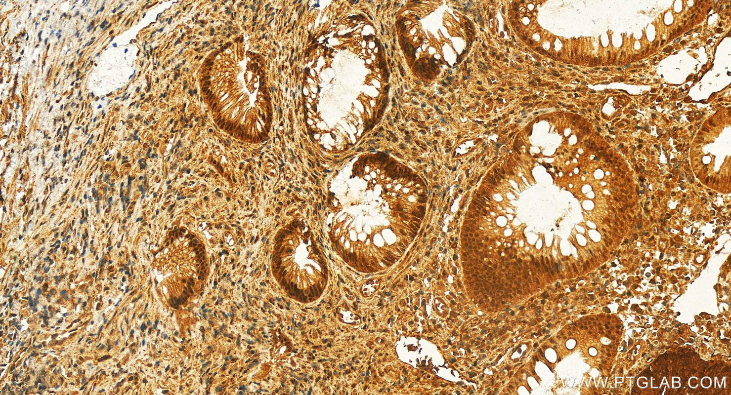 Immunohistochemical analysis of paraffin-embedded human colon cancer slide using 25964-1-AP (Icln antibody) at dilution of 1:200 (under 20x lens). Heat mediated antigen retrieval with Tris-EDTA buffer (pH 9.0). IHC staining of human colon cancer using 25964-1-AP