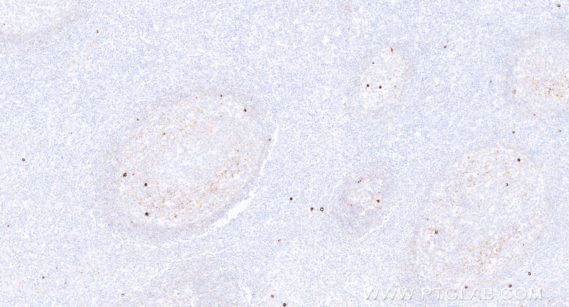 IHC staining of human tonsillitis using 98744-1-RR IHC staining of human tonsillitis using 98744-1-RR