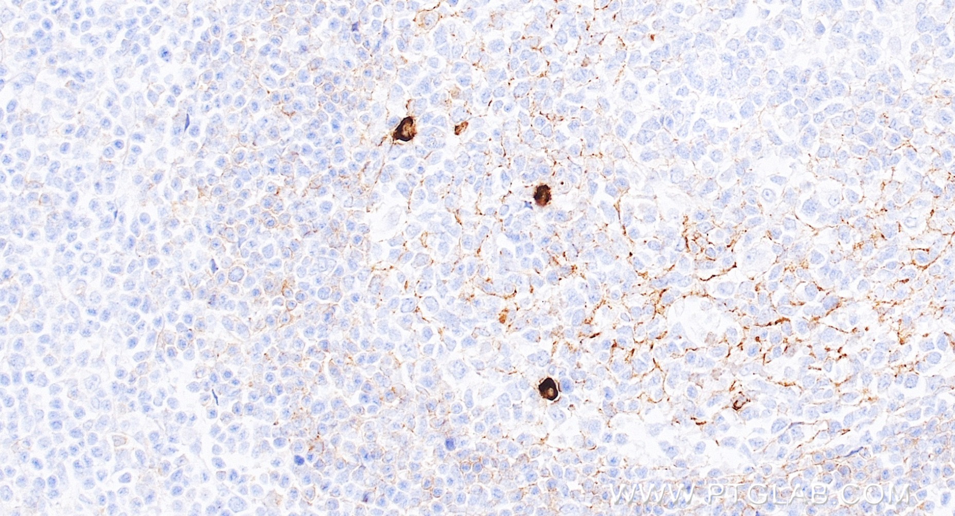 IHC staining of human tonsillitis using 98744-1-RR IHC staining of human tonsillitis using 98744-1-RR