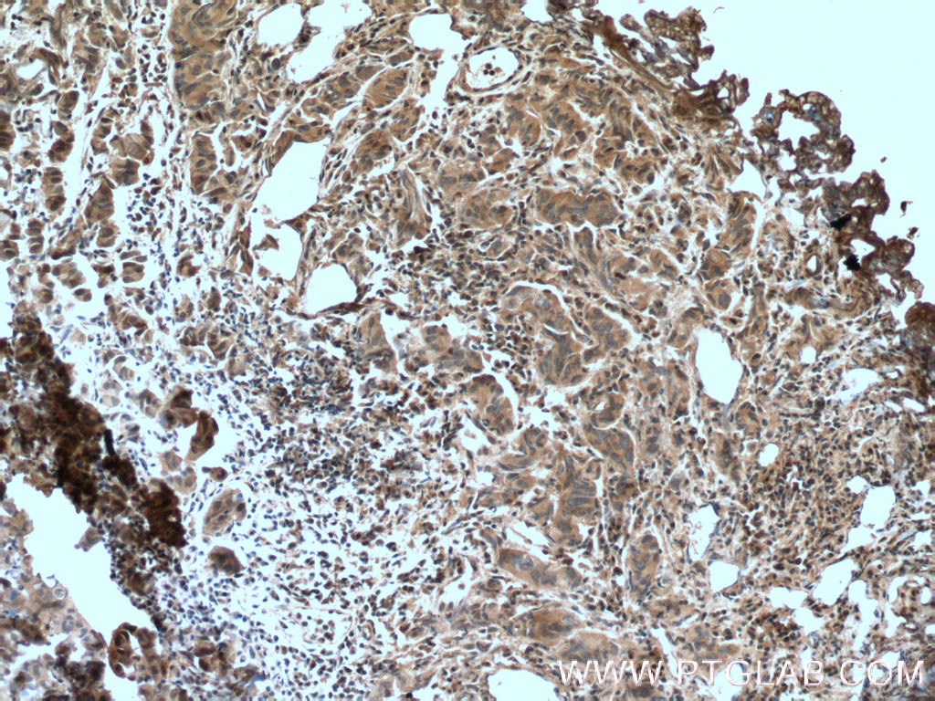 IHC staining of human prostate cancer using 66418-1-Ig (same clone as 66418-1-PBS)