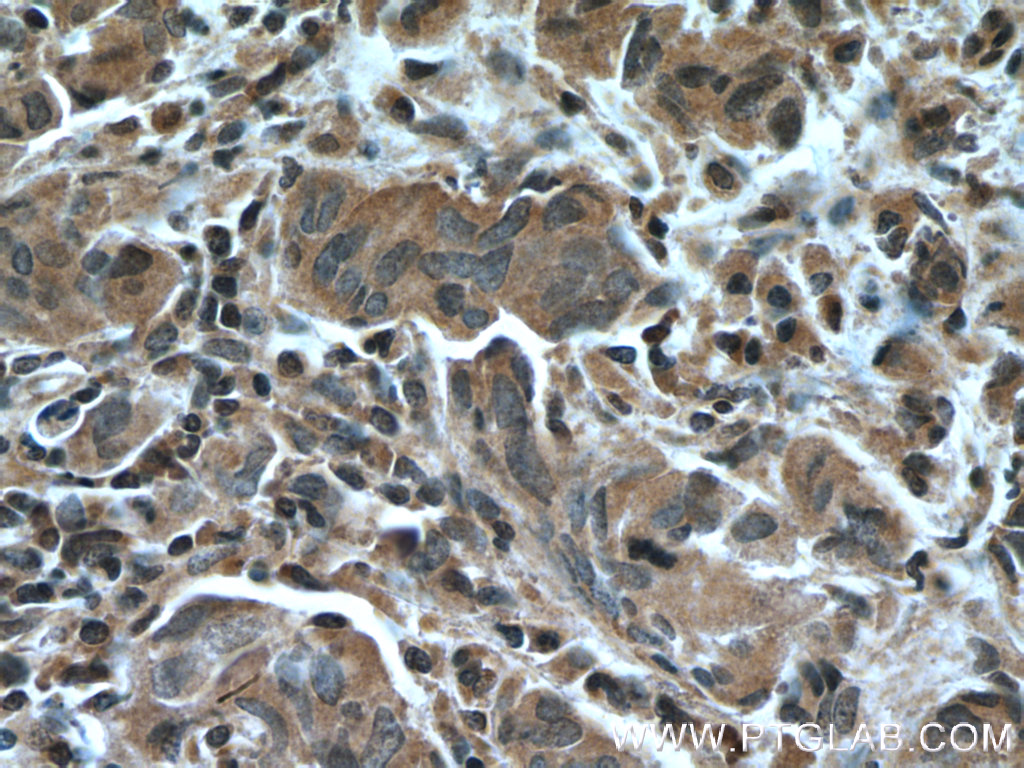 IHC staining of human prostate cancer using 66418-1-Ig (same clone as 66418-1-PBS)