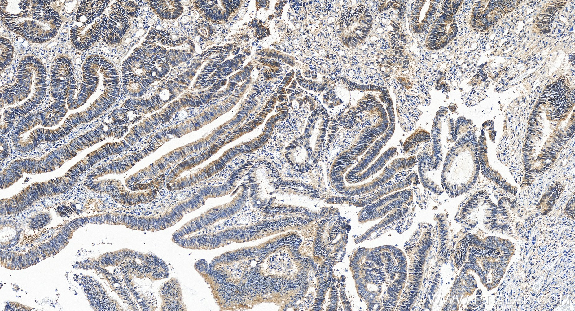 IHC staining of human colon cancer using 80019-1-RR (same clone as 80019-1-PBS)