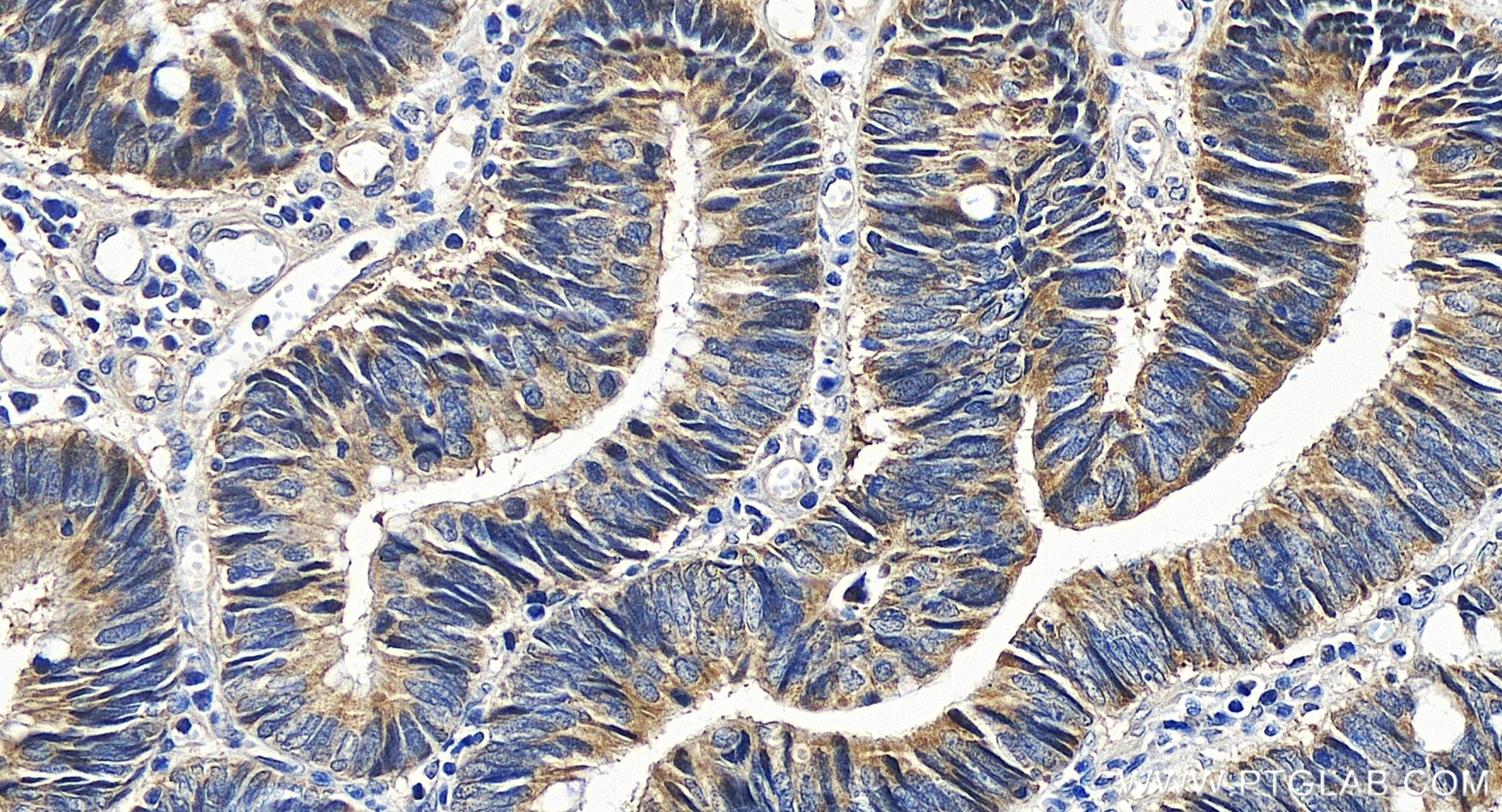 IHC staining of human colon cancer using 80019-1-RR (same clone as 80019-1-PBS)