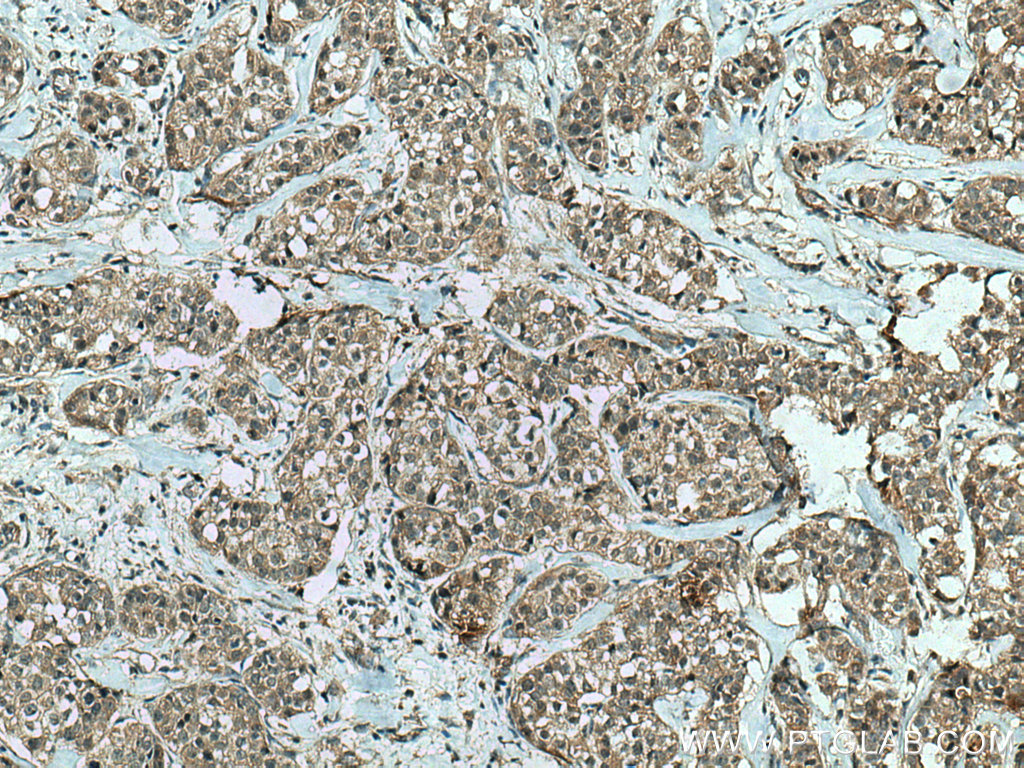 IHC staining of human breast cancer using 80019-1-RR