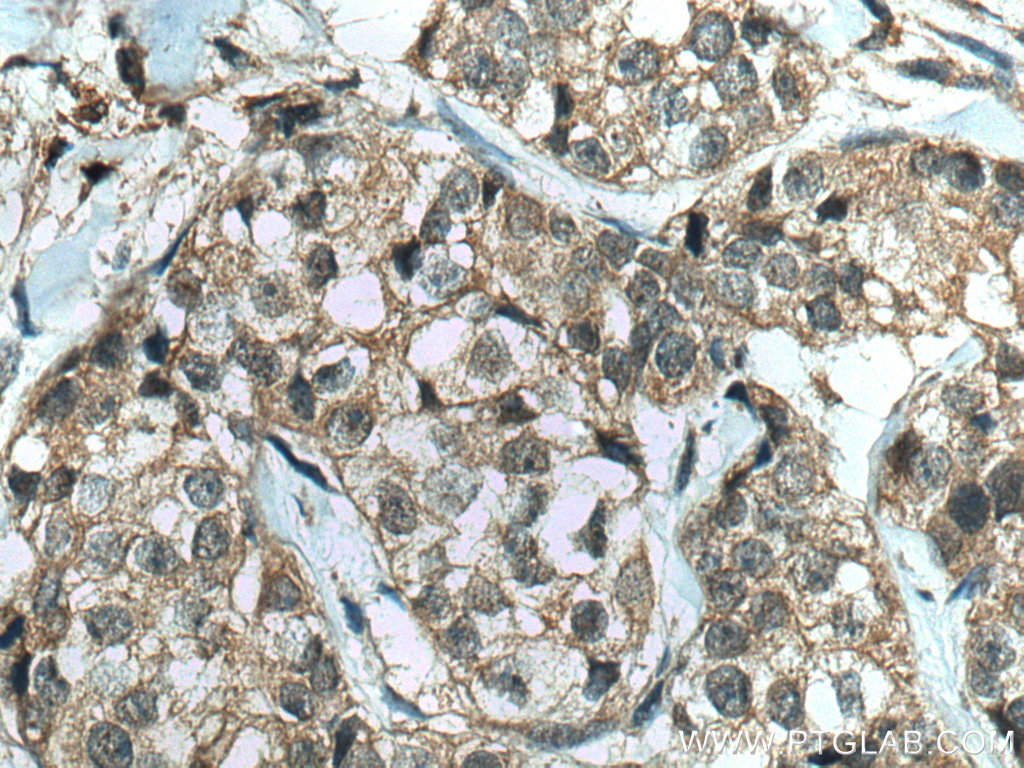 IHC staining of human breast cancer using 80019-1-RR (same clone as 80019-1-PBS)