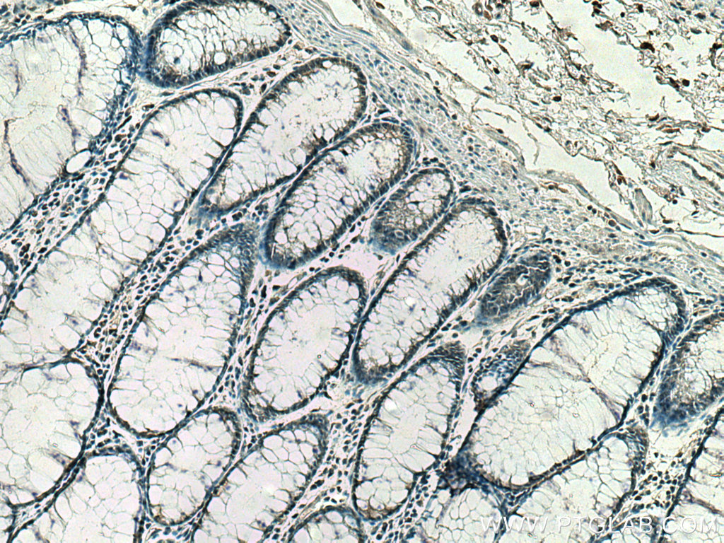 IHC staining of human colon cancer using 67597-1-Ig (same clone as 67597-1-PBS)