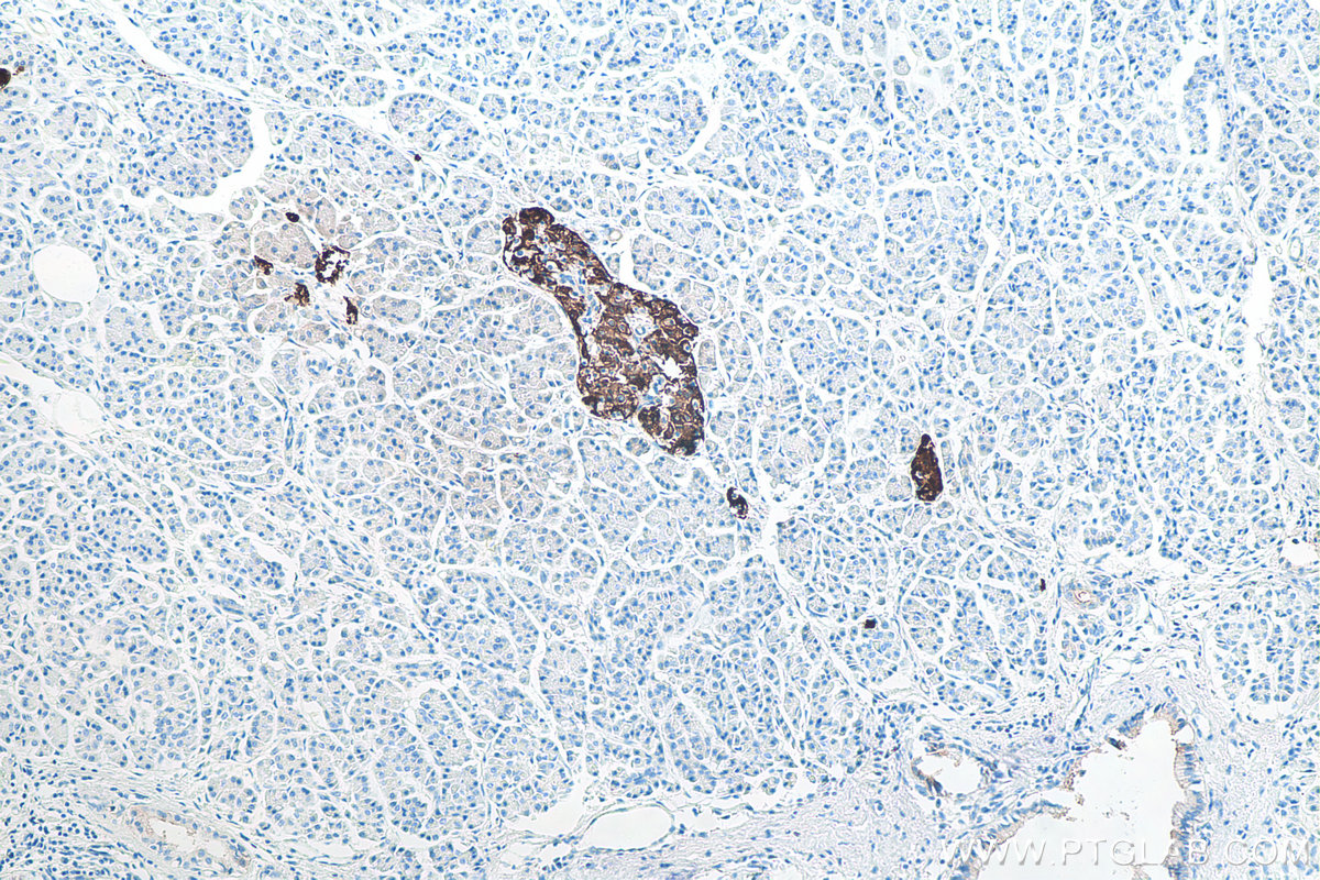 IHC staining of human pancreas cancer using 66198-1-Ig IHC staining of human pancreas cancer using 66198-1-Ig