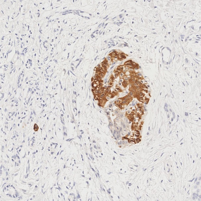 IHC staining of human pancreas cancer using 66198-1-Ig IHC staining of human pancreas cancer using 66198-1-Ig