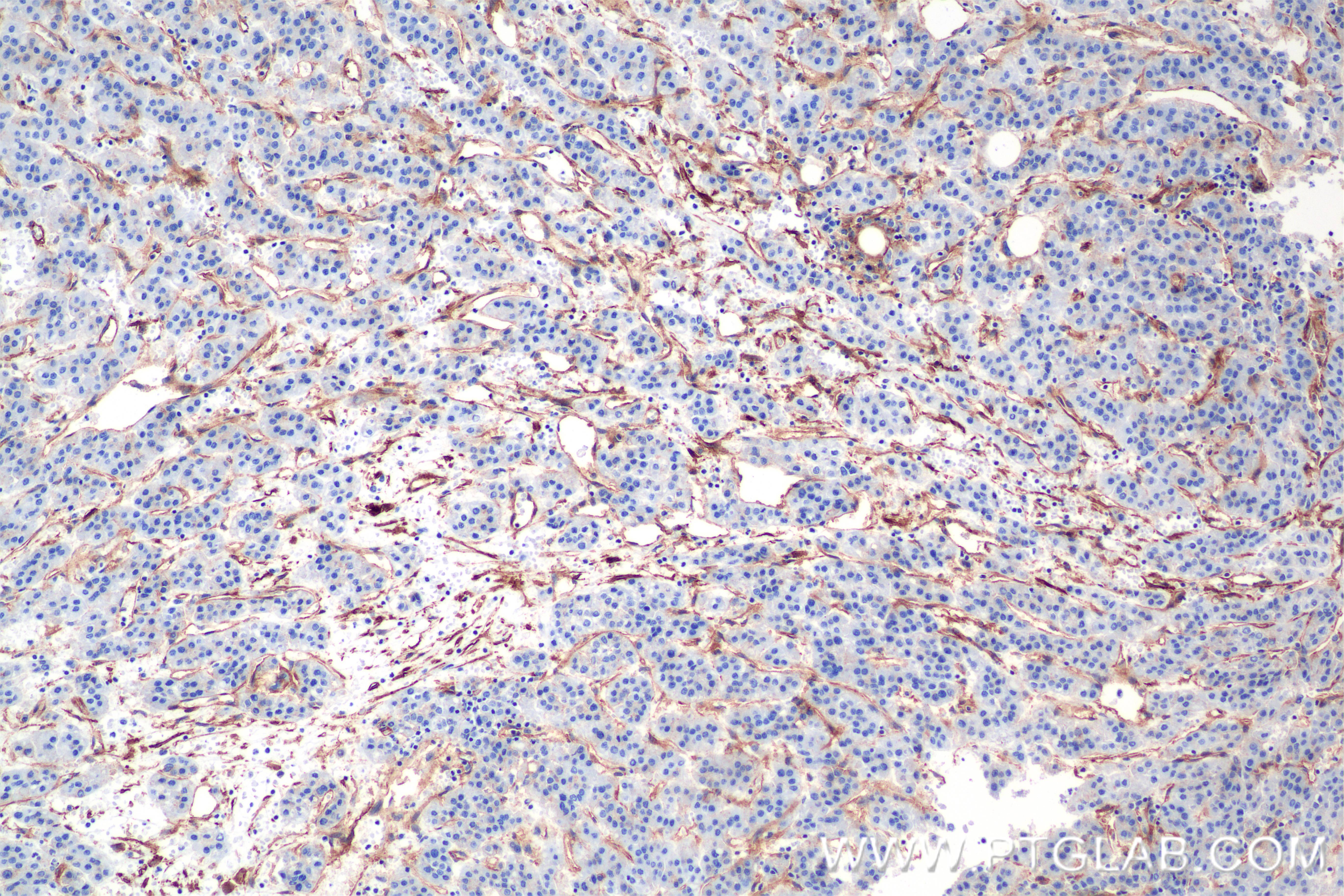 IHC staining of human hepatocellular cancer using 84883-5-RR (same clone as 84883-5-PBS)