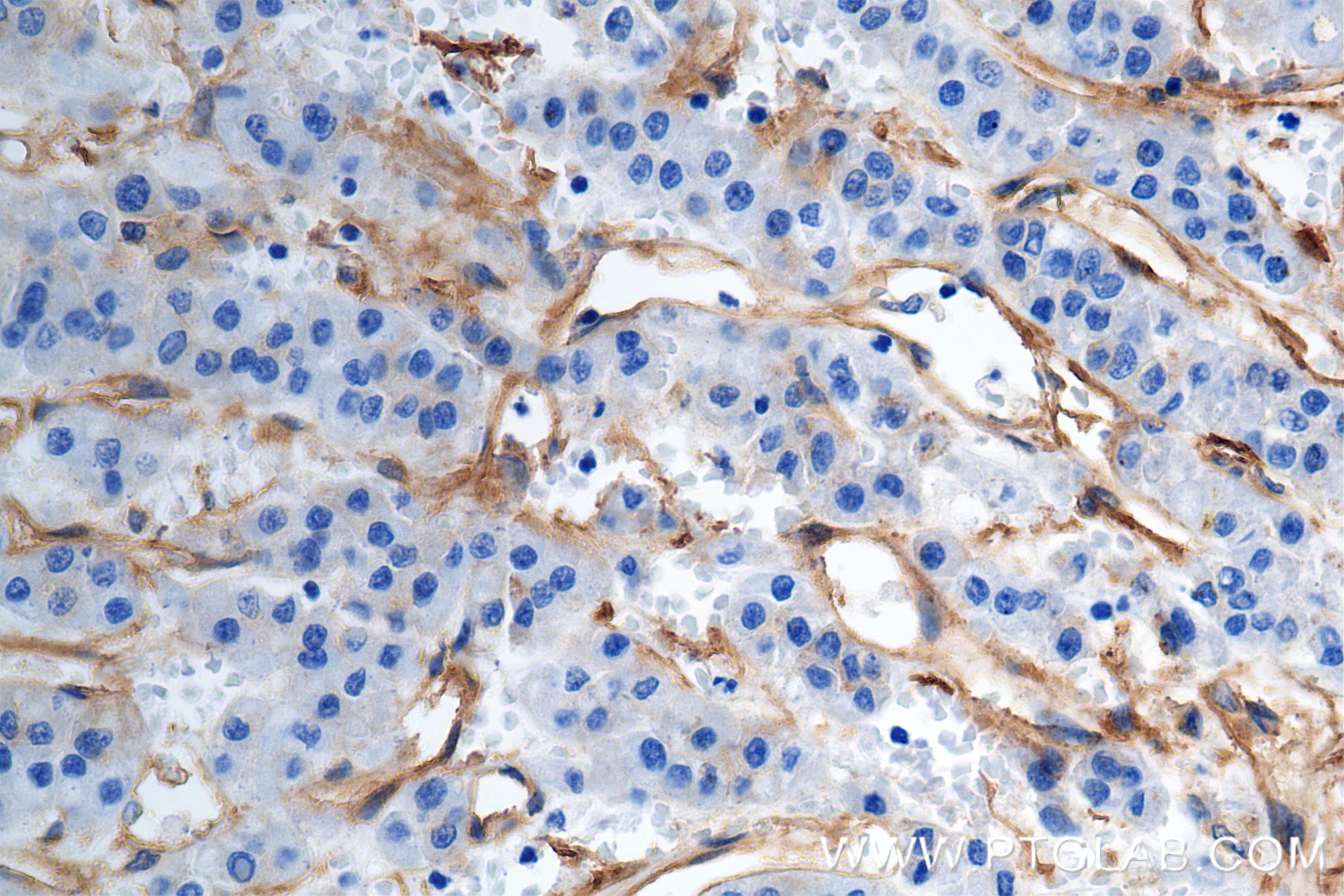 IHC staining of human hepatocellular cancer using 84883-5-RR (same clone as 84883-5-PBS)