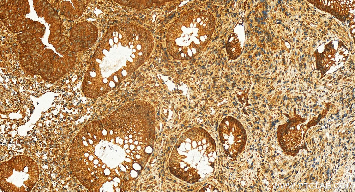 IHC staining of human colon  cancer using 30703-1-AP