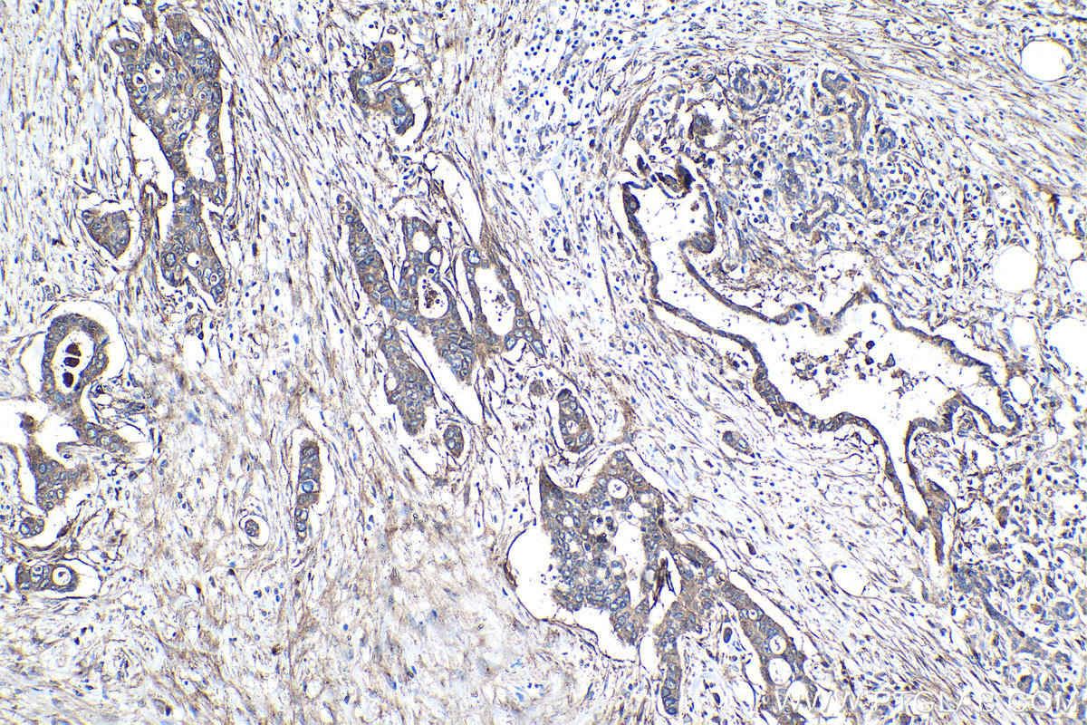 IHC staining of human pancreas cancer using 28543-1-AP