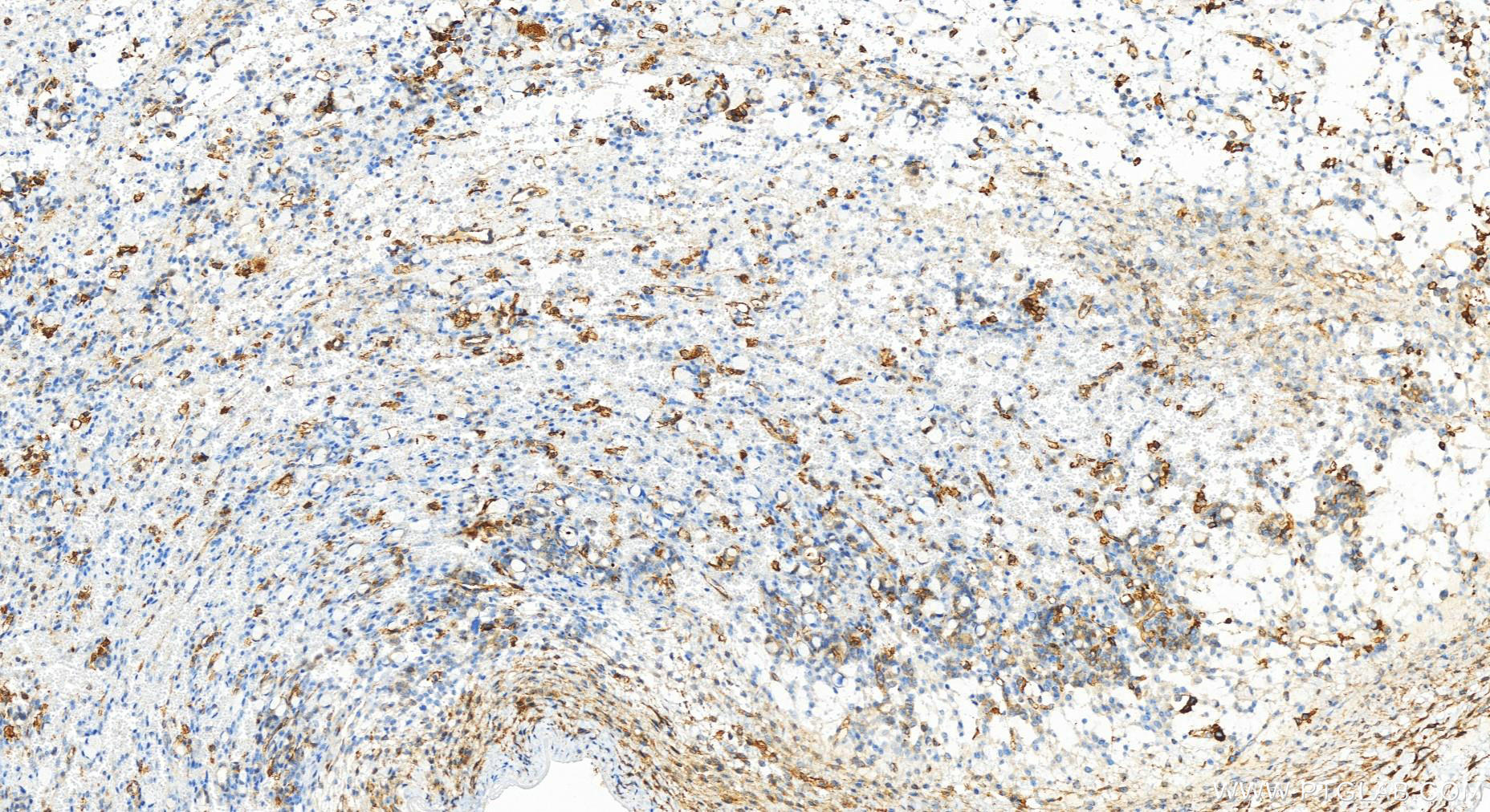 IHC staining of human ovary cancer using 83514-3-RR (same clone as 83514-3-PBS)