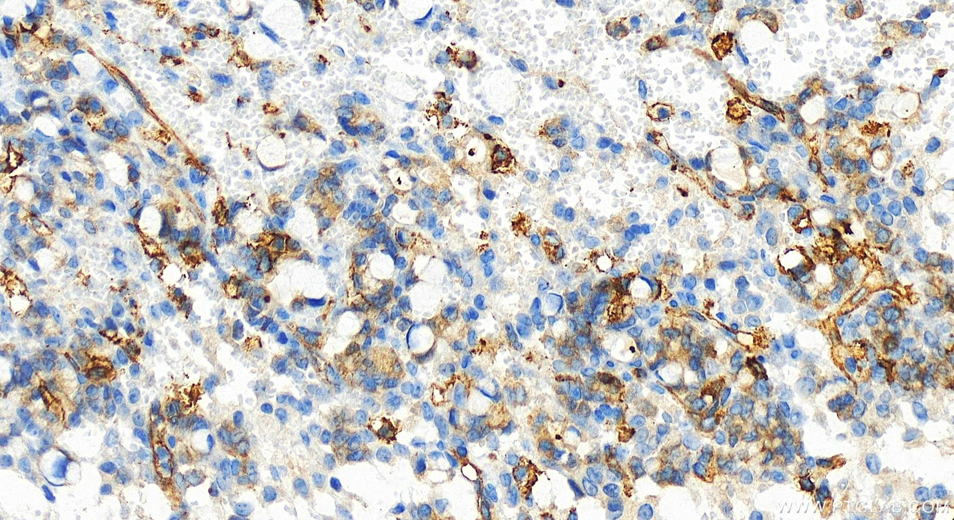 IHC staining of human ovary cancer using 83514-3-RR (same clone as 83514-3-PBS)