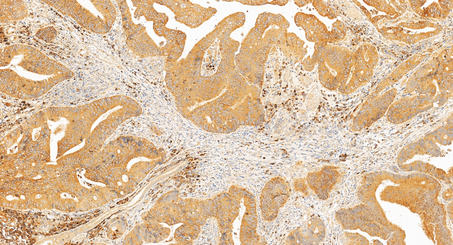 IHC staining of human colon cancer using 34193-1-AP IHC staining of human colon cancer using 34193-1-AP