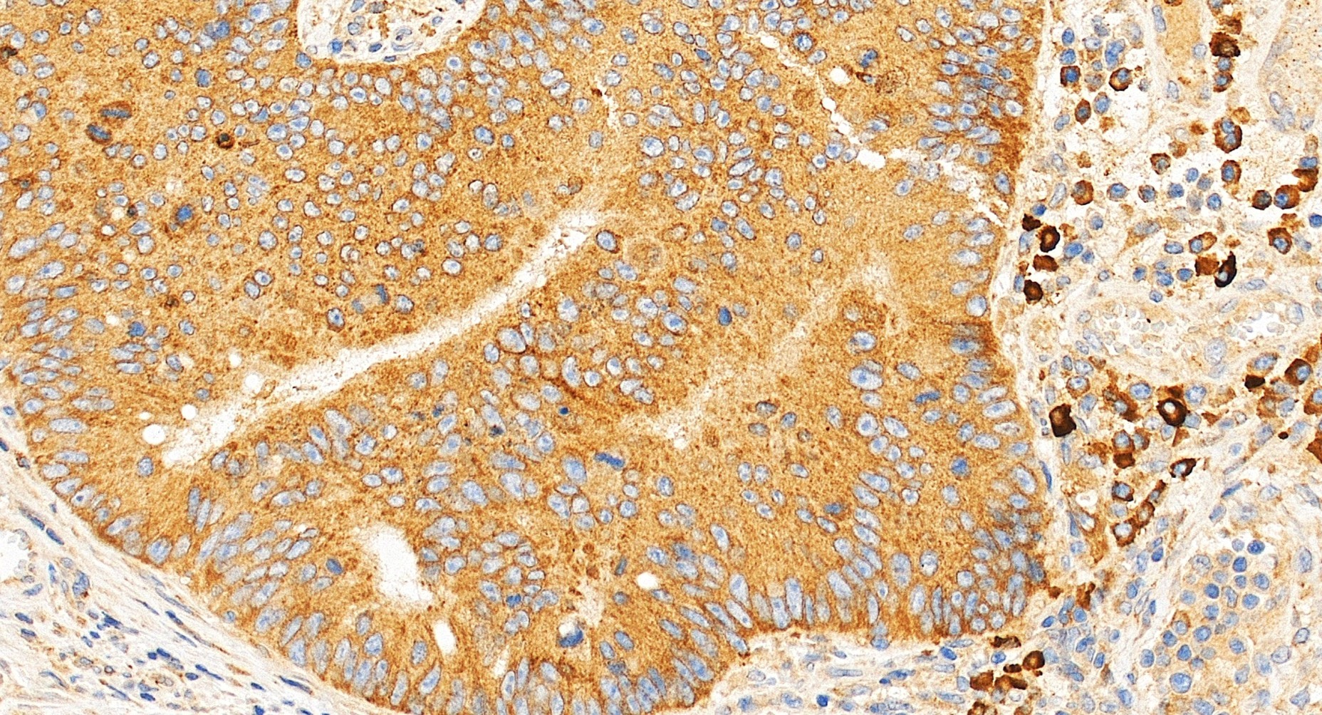 IHC staining of human colon cancer using 34193-1-AP IHC staining of human colon cancer using 34193-1-AP