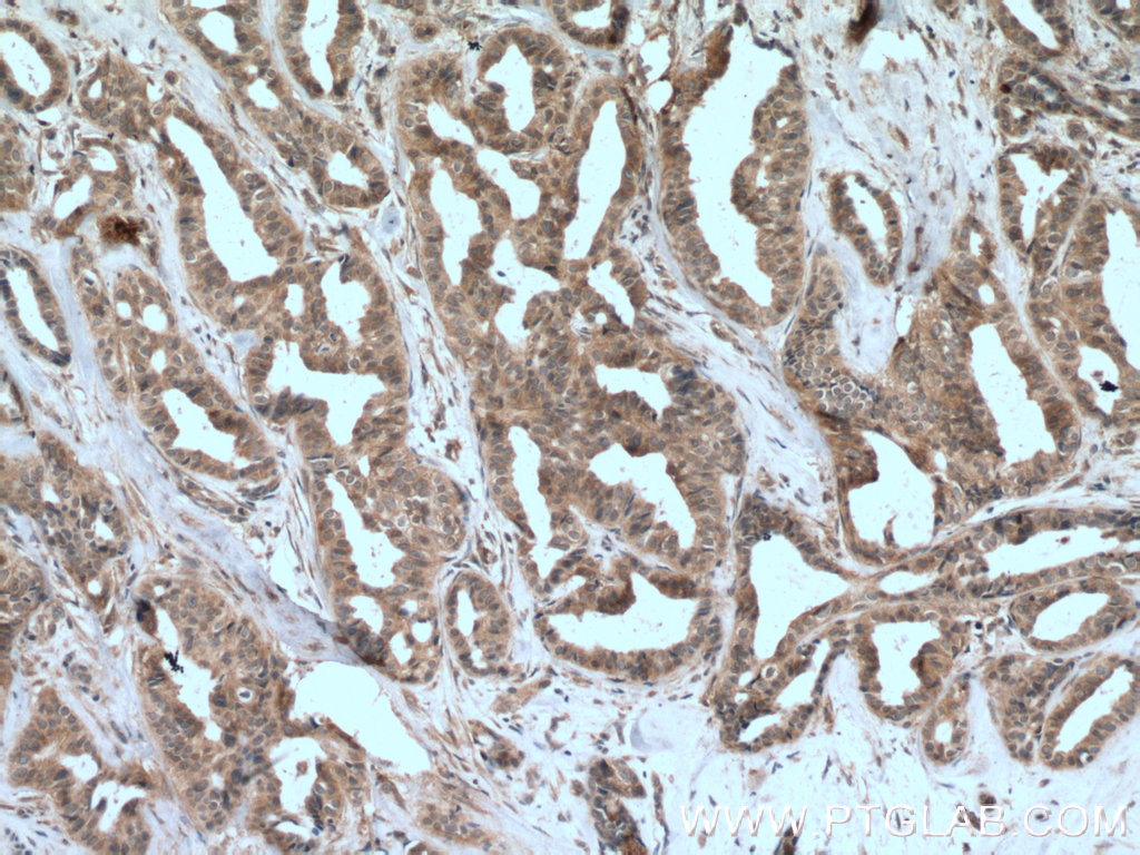 IHC staining of human breast cancer using 66466-1-Ig