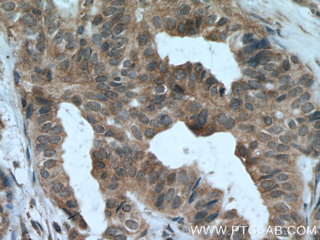IHC staining of human breast cancer using 66466-1-Ig