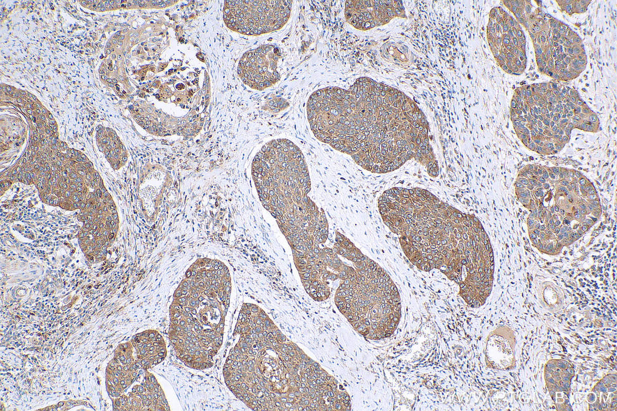 IHC staining of human oesophagus cancer using 14568-1-AP