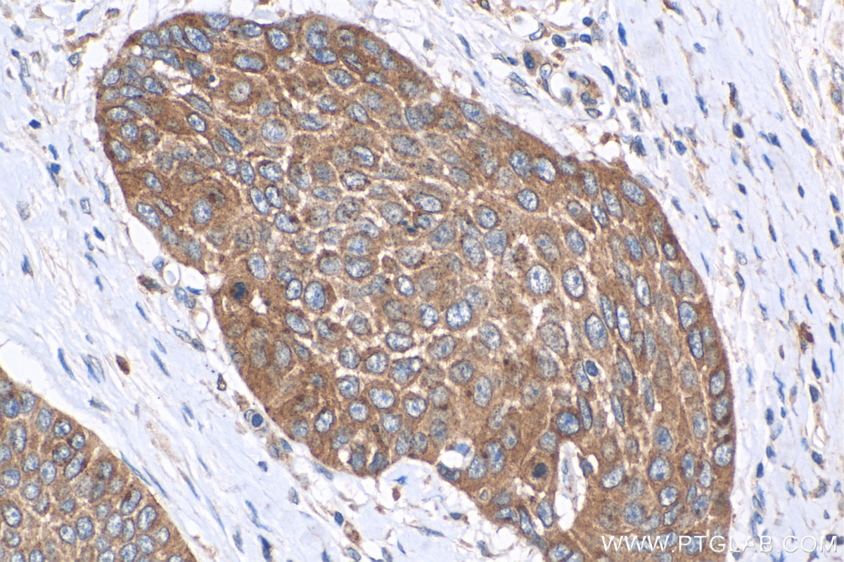 IHC staining of human oesophagus cancer using 14568-1-AP