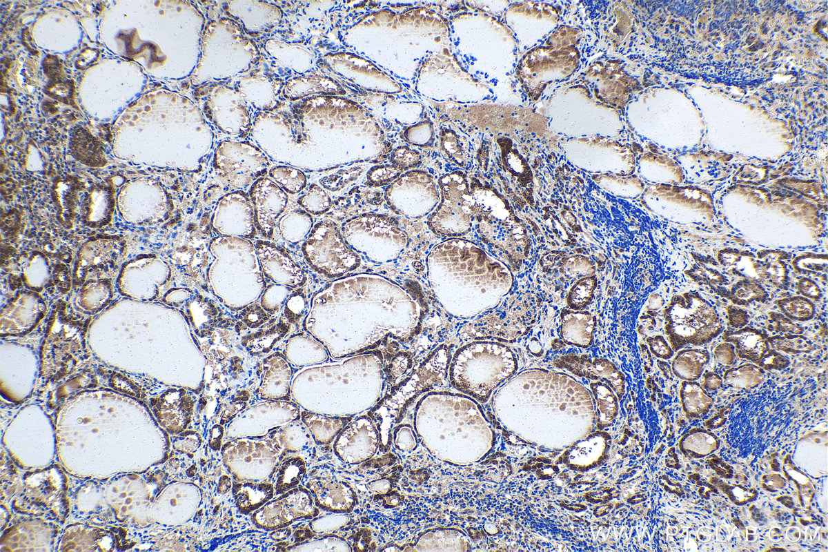 IHC staining of human thyroid cancer using 21168-1-AP IHC staining of human thyroid cancer using 21168-1-AP