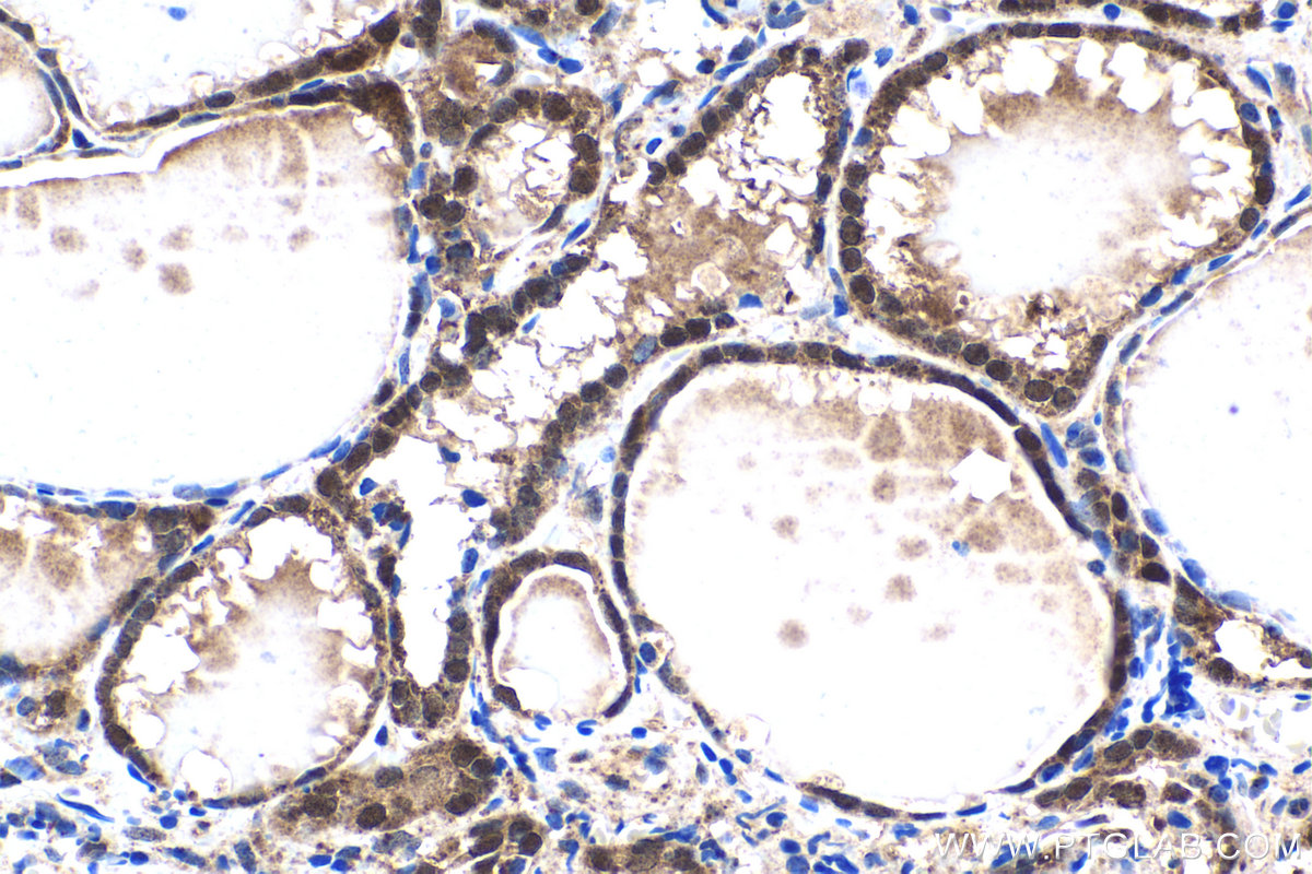 IHC staining of human thyroid cancer using 21168-1-AP IHC staining of human thyroid cancer using 21168-1-AP