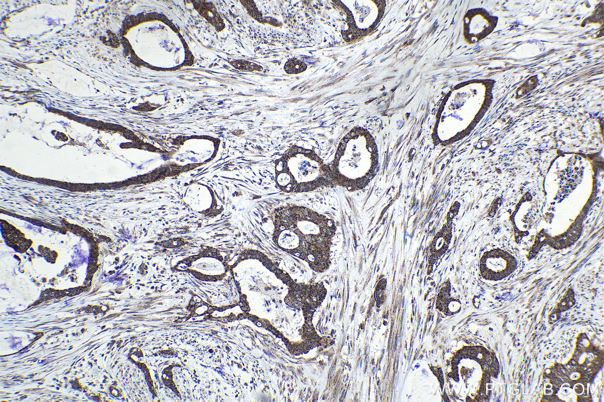 IHC staining of human urothelial carcinoma using 21168-1-AP IHC staining of human urothelial carcinoma using 21168-1-AP