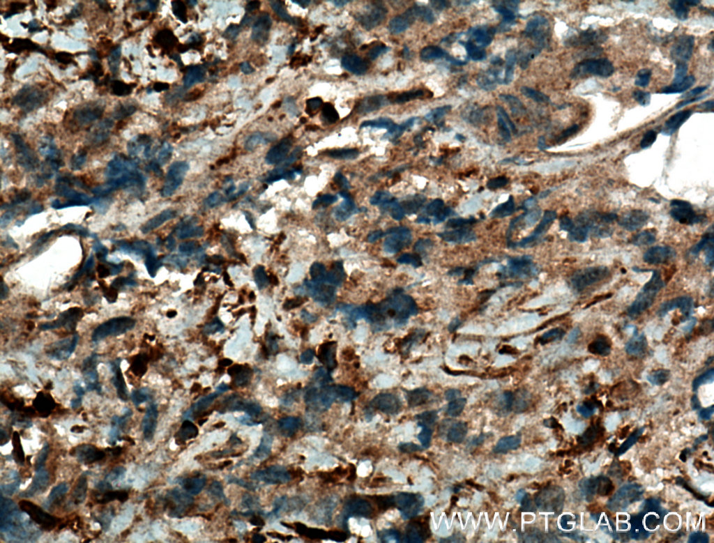 IHC staining of human prostate cancer using 10023-1-AP