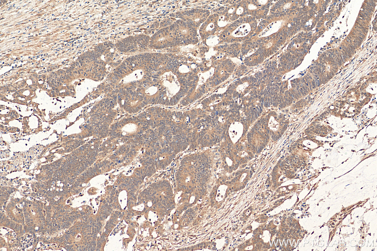 IHC staining of human colon cancer using 24164-1-AP