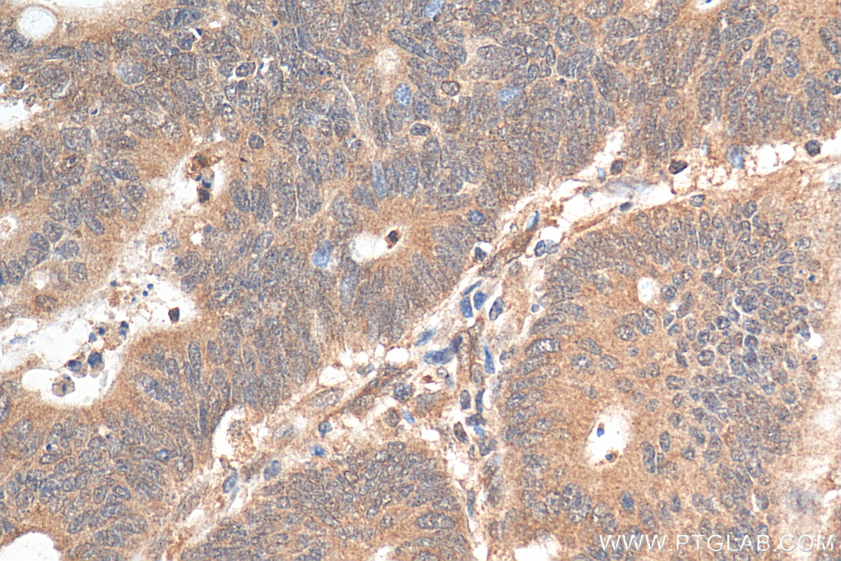 IHC staining of human colon cancer using 24164-1-AP
