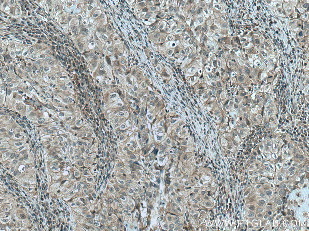 IHC staining of human lung cancer using 66210-1-Ig (same clone as 66210-1-PBS)