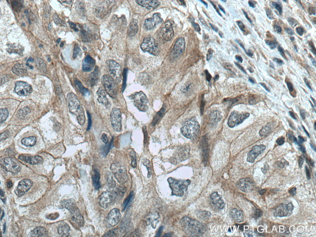 IHC staining of human lung cancer using 66210-1-Ig