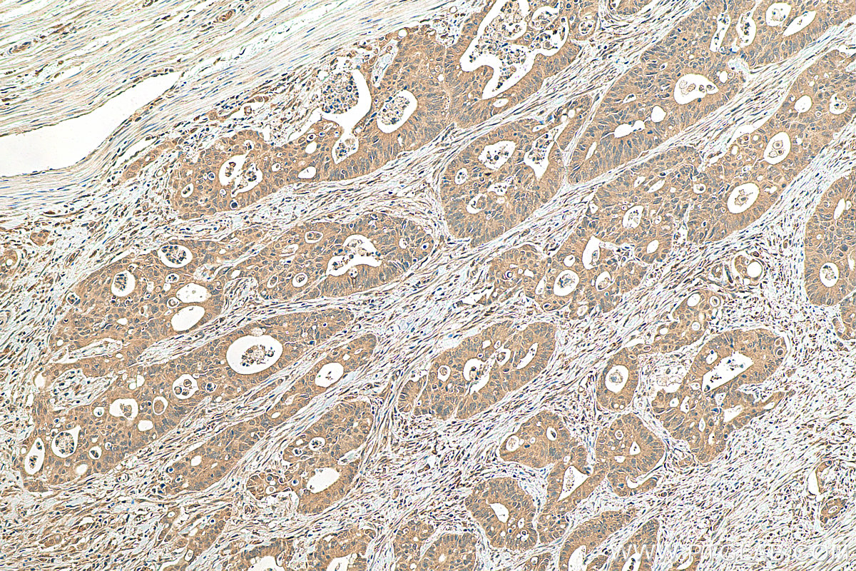 IHC staining of human colon cancer using 81629-1-RR (same clone as 81629-1-PBS)