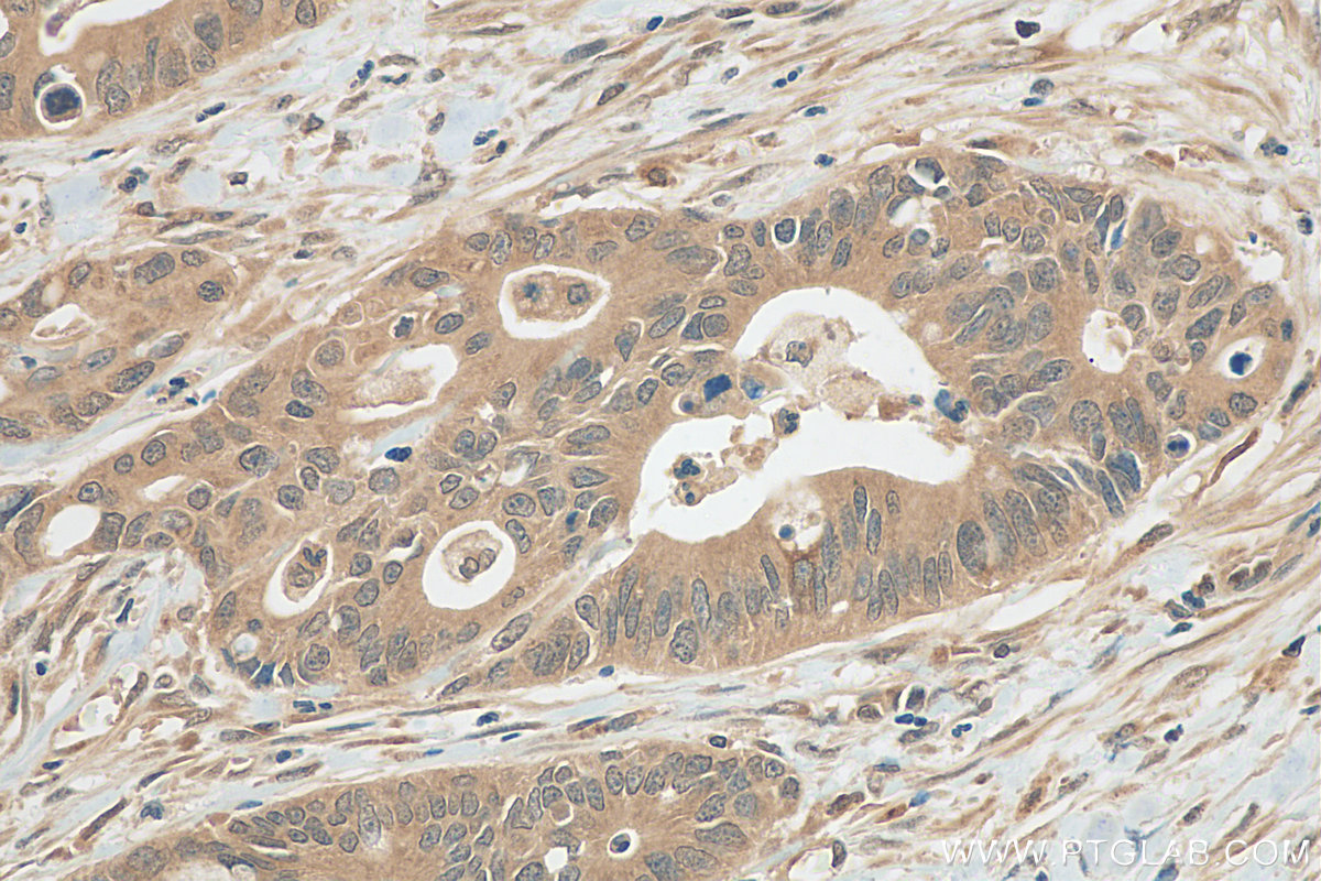 IHC staining of human colon cancer using 81629-1-RR (same clone as 81629-1-PBS)