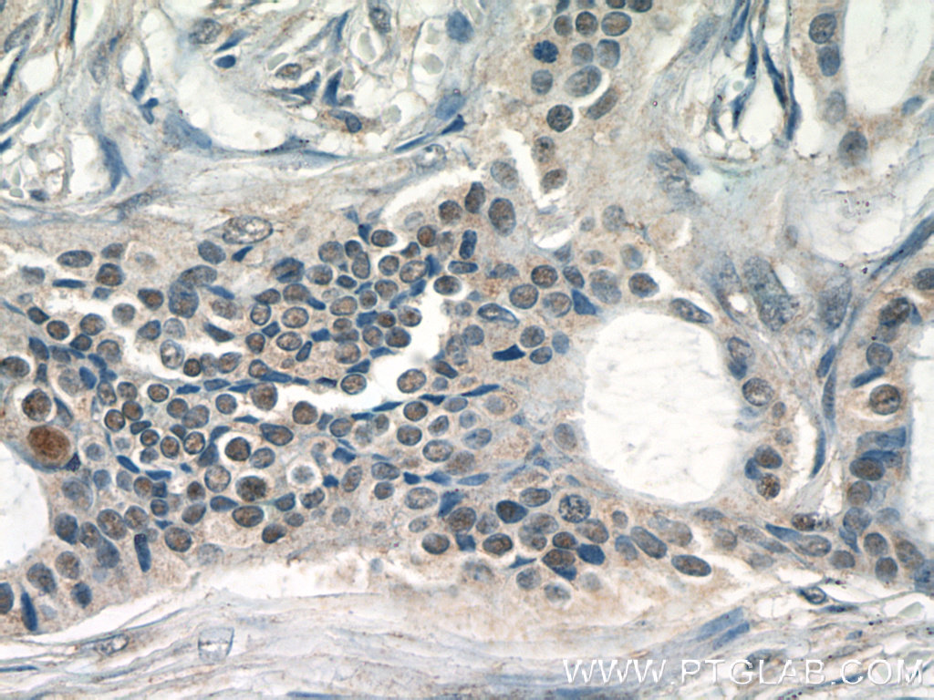 IHC staining of human breast cancer using 24909-1-AP