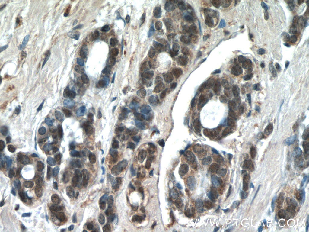 IHC staining of human cervical cancer using 24909-1-AP