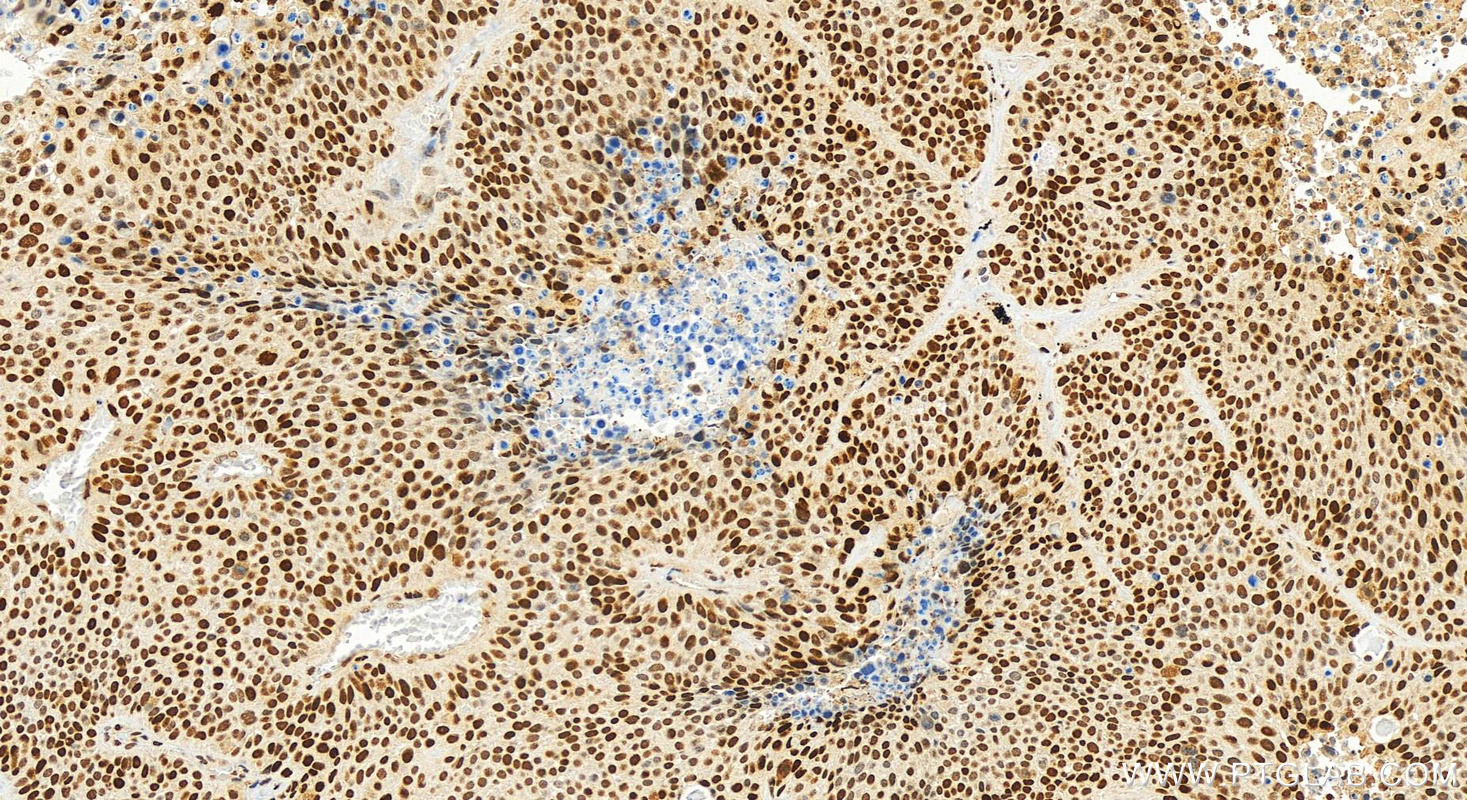 IHC staining of human lung squamous cell cancer using 24909-1-AP