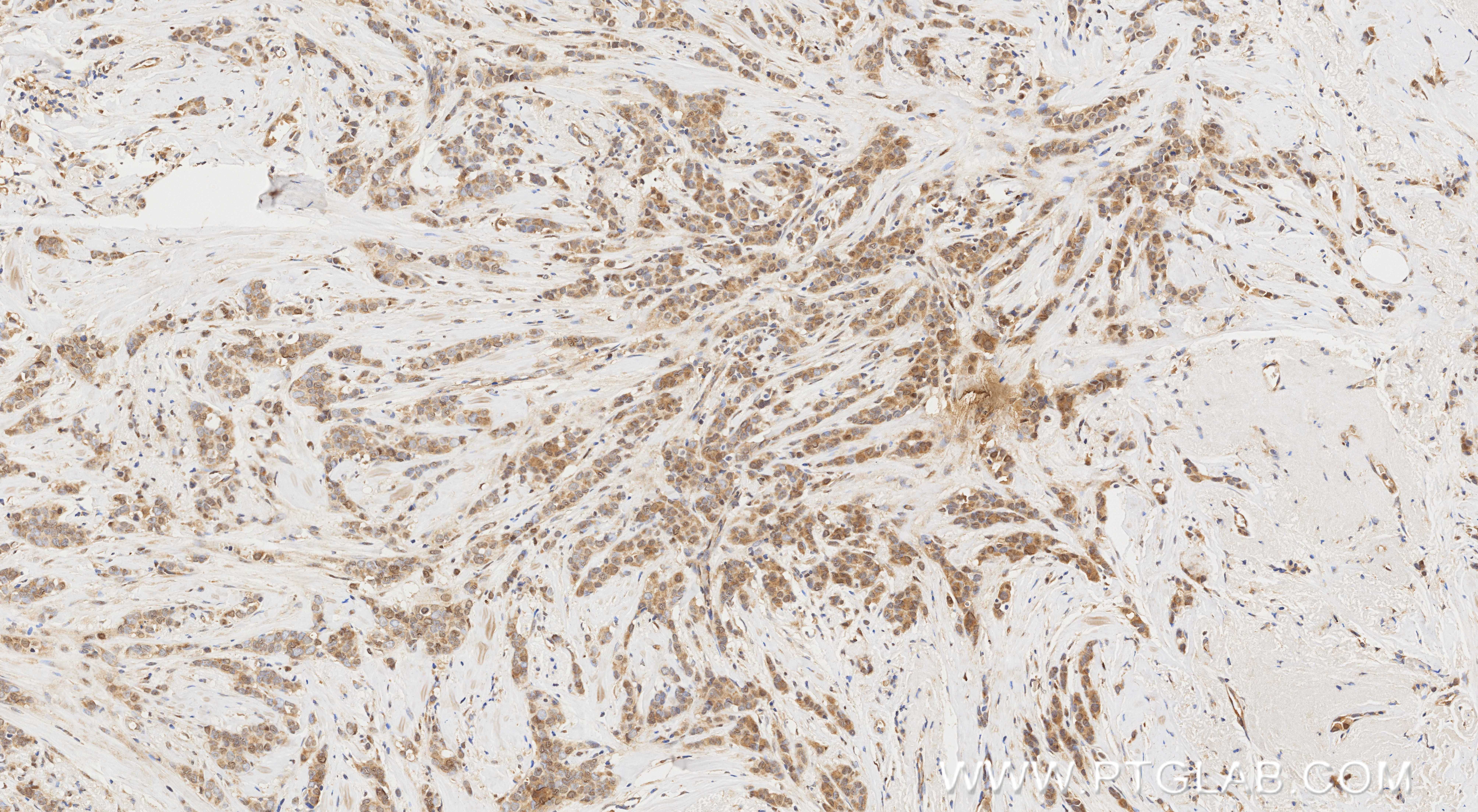 IHC staining of human breast cancer using 81667-5-RR (same clone as 81667-5-PBS) IHC staining of human breast cancer using 81667-5-RR (same clone as 81667-5-PBS)