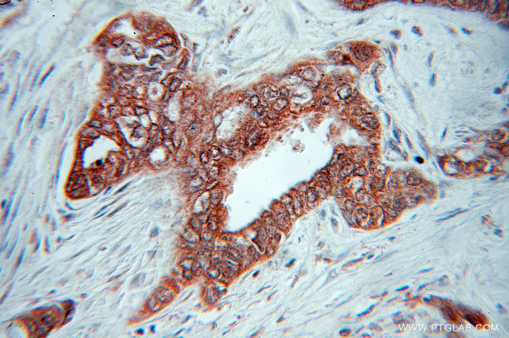 IHC staining of human pancreas cancer using 11146-1-AP