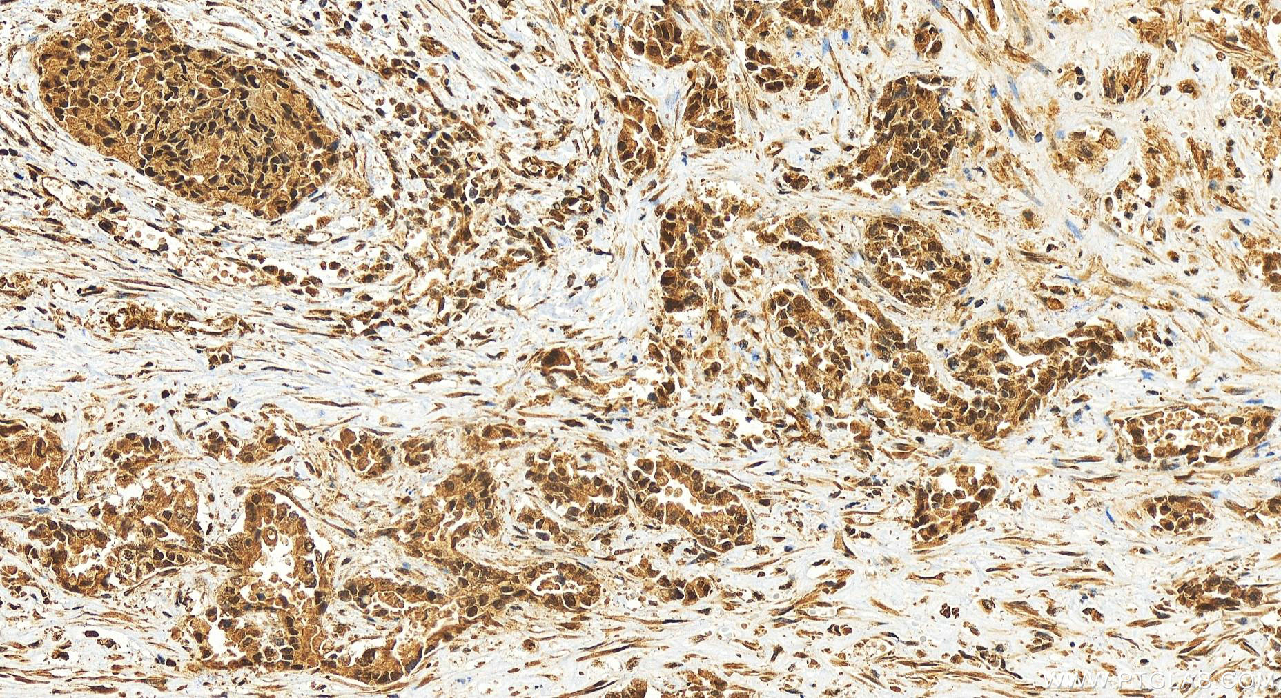 IHC staining of human intrahepatic cholangiocarcinoma using 25533-1-AP