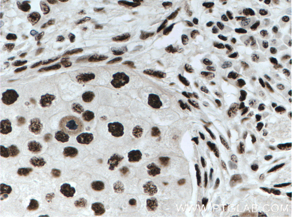 IHC staining of human breast cancer using 66630-1-Ig